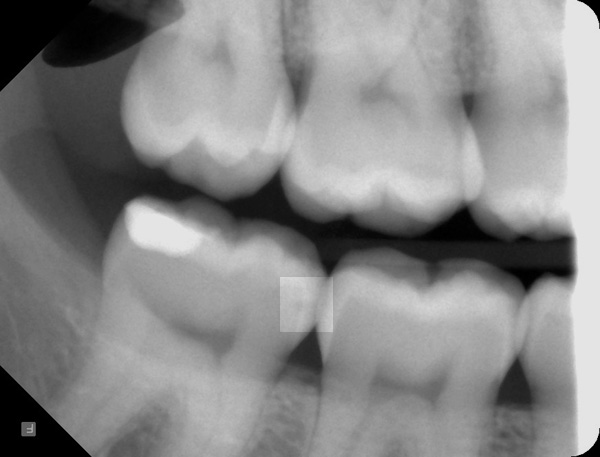 Zahnzwischenraumkaries-Roentgen