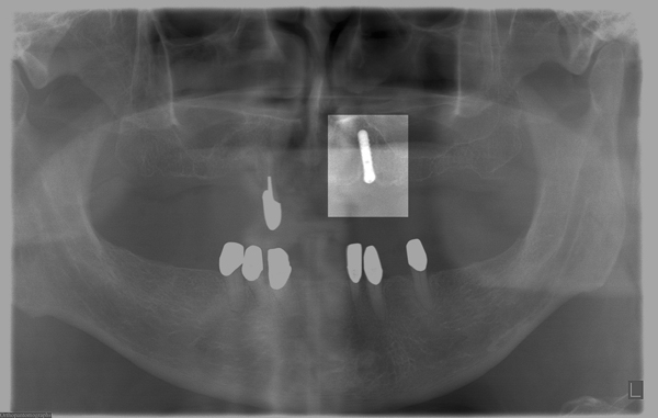 Implantat-fuer-Eckzahn-web