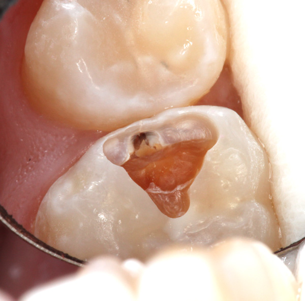 Zahnzwischenraumkaries-3