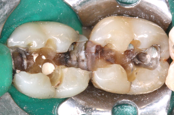 Amalgamentfernung-Karies-unter-Amalgam-und-an-Zahnzwischenraumflaechen