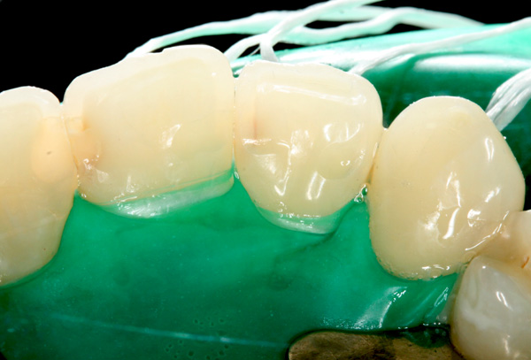 Zahnzwischenraumkaries-Oberkierfer-Frontzaehne-Ausgangsfoto