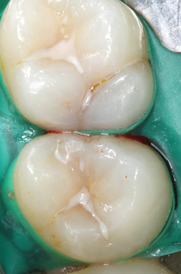 Zahnzwischenraumkaries-Ausgangsfoto