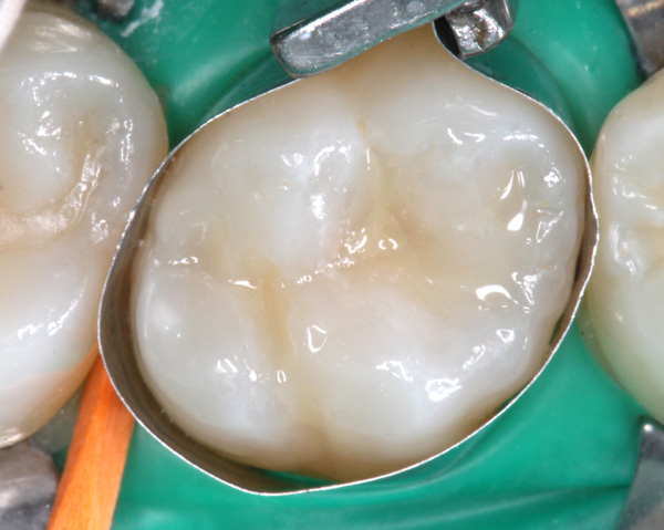 Zahnzwischenraumkaries-Komposit