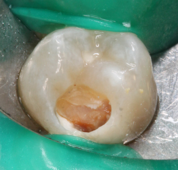 Zahnzwischenraumkaries-eroeffnet