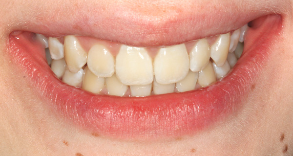 smile2