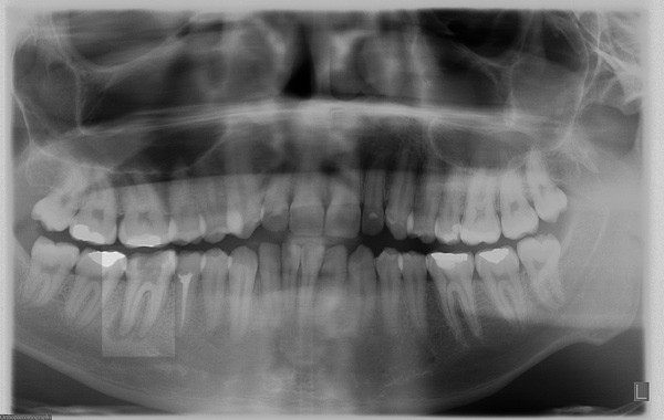 Endo-46-OPG-