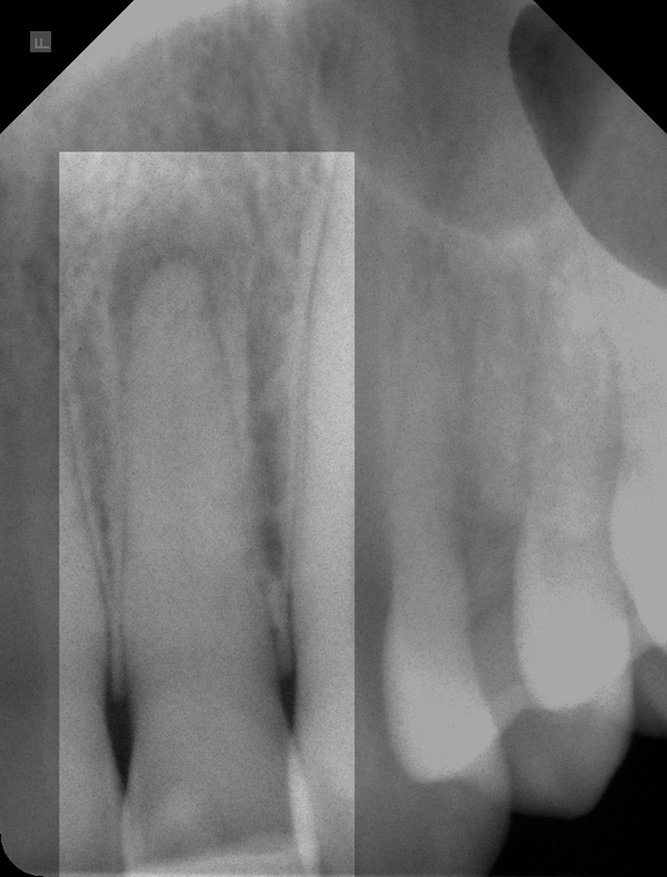 Endo-22-Ausgang- Endo-22-Ausgang-