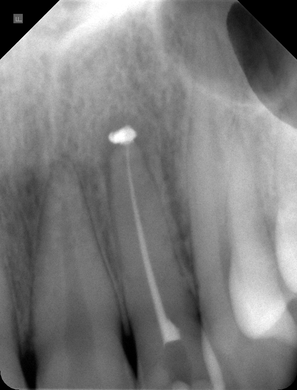 Endo22WF- Endo22WF-