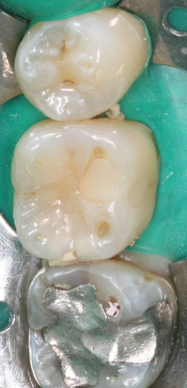 Zahnzwischenraumkaries-1