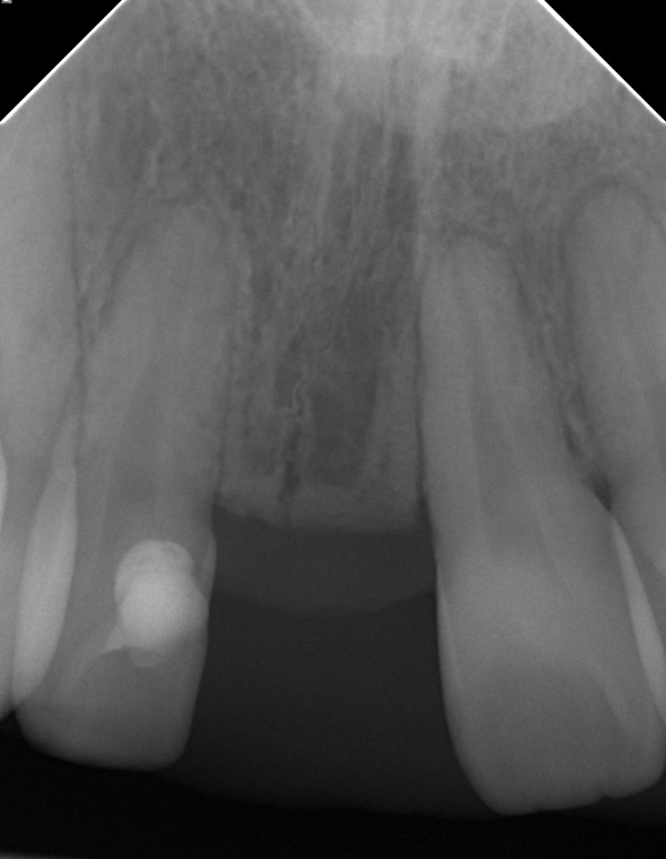 Ausgang-intraorales-Roe