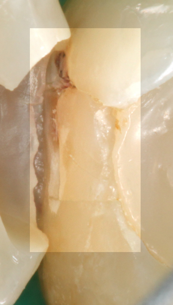 Fuellungsrandkaries-1-Detail