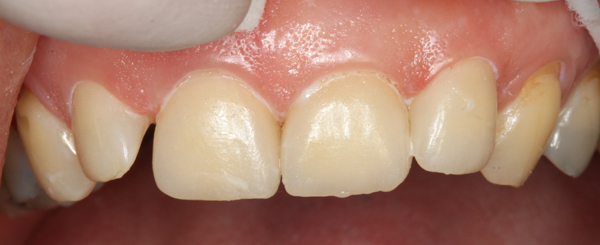 Keramikveneers-11-21-22-b