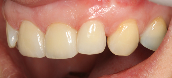 Keramikveneers-11-21-22-f