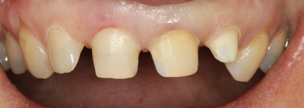 Keramikveneers-11-21-22-praep