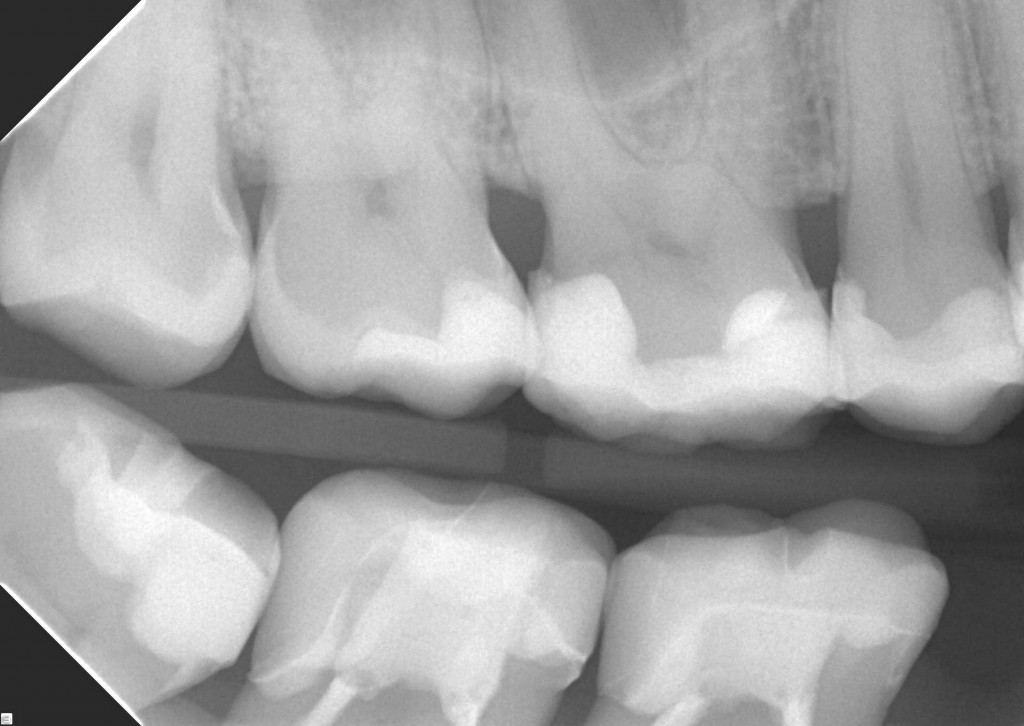 Karies | Zahnnotizen