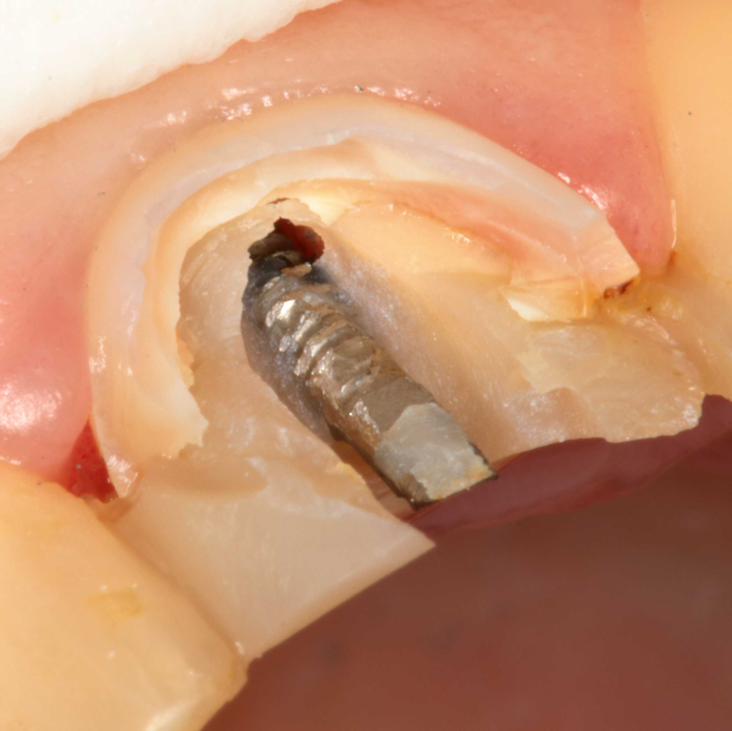 Stupf-mit-Schraube