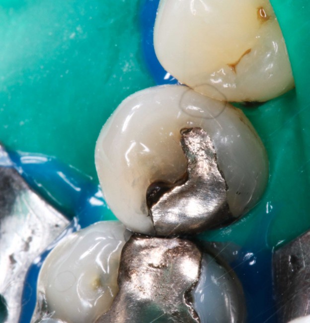 adhäsive Zahnheilkunde Zahnnotizen