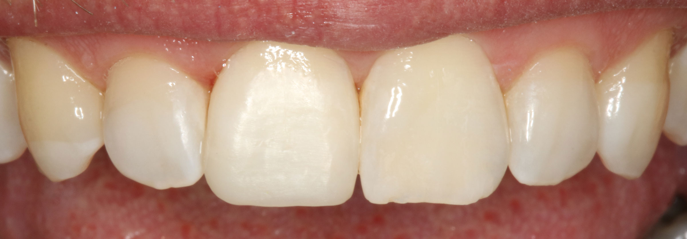 11-bleichen-und-komposit-lippenlinie