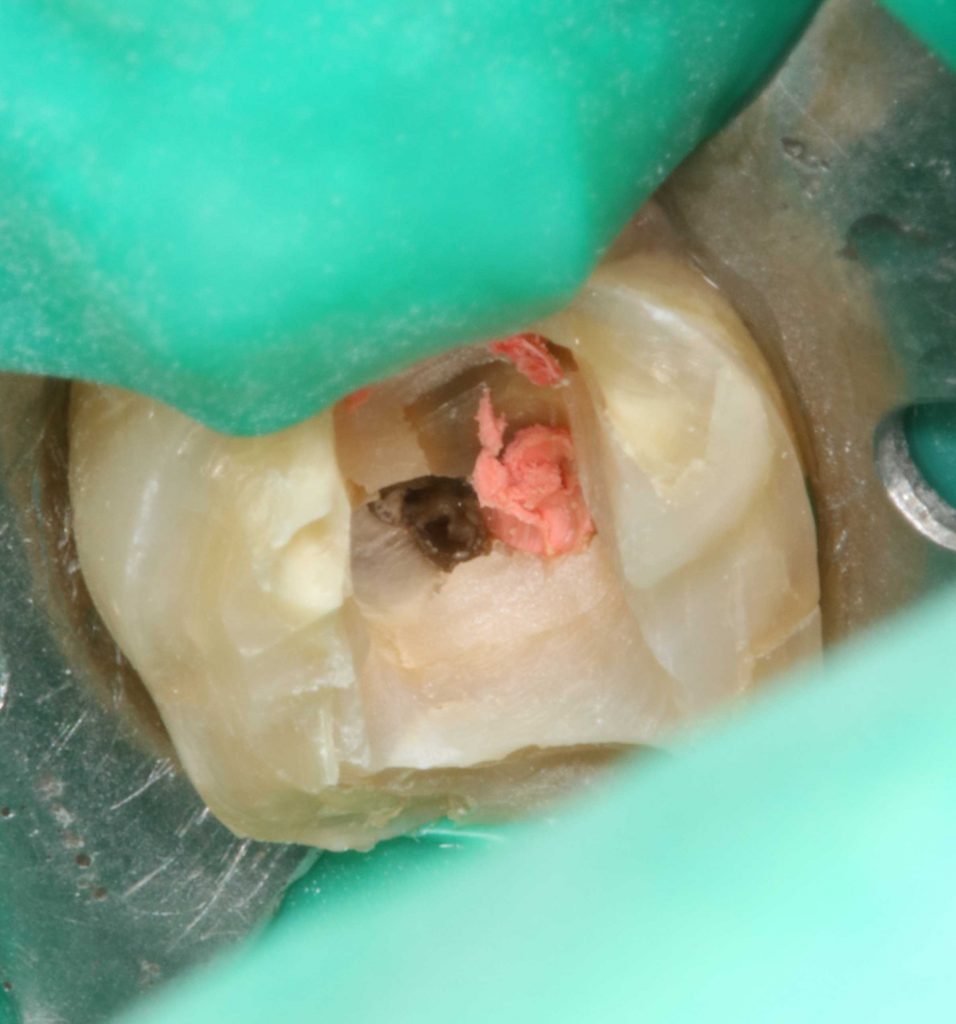 Revision einer Wurzelkanalbehandlung Zahnnotizen